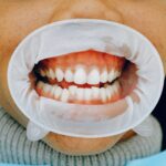 Is oral surgery covered by blue cross medical insurance?